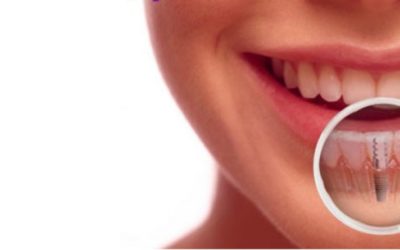 Implantes dentales en Clínica Dental Samprodent