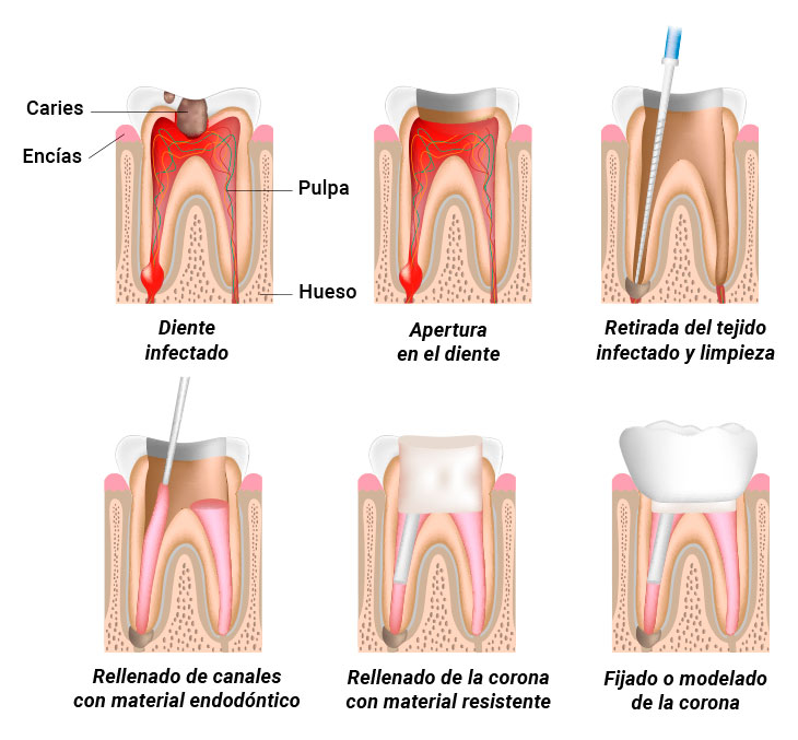 ¿Qué es un tratamiento de endodoncia? | Clínica Dental San Blas Madrid