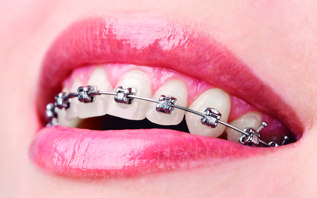 ¿Qué es la ortodoncia?