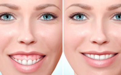 Sonrisa Gingival: causas y soluciones