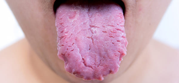 La lengua agrietada: Causas y tratamientos